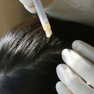 Qué tipo de caída de cabello tienes y cómo tratarla
