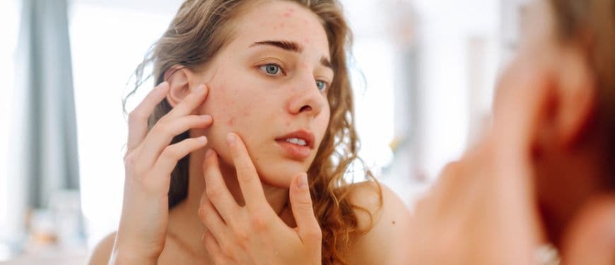 Qué es la urticaria por estrés y cómo identificarla: síntomas y tratamientos