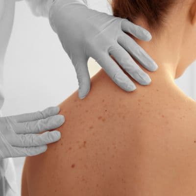 Cuánto tiempo puede tardar un melanoma en hacer metástasis