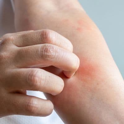 Dermatitis atópica: cómo reequilibrar la flora de la piel para calmar los brotes