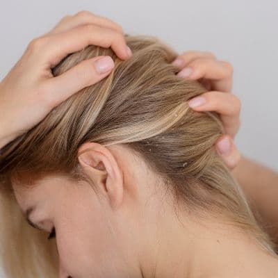 Costras en la cabeza: Diferenciar psoriasis, dermatitis o tiña