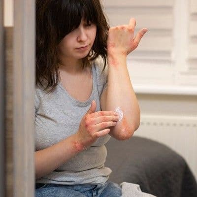 Dermatitis herpetiforme: la 'alergia al gluten' que se manifiesta en tu piel