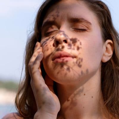 ¿Lentigos, melasma o HPI? Ponle nombre a tus manchas faciales y elimínalas