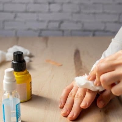 Dermatitis de contacto irritativa en manos según la AEDV
