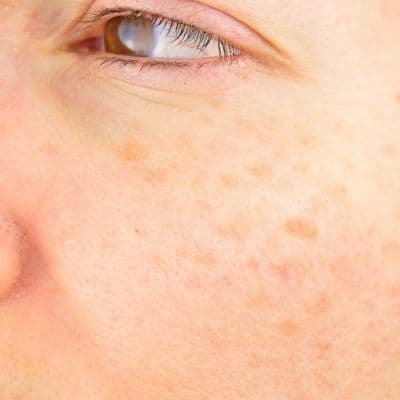 Adiós a las manchas: la guía definitiva para usar retinol y unificar tu tono