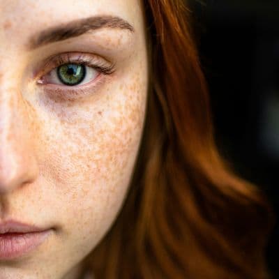 Por qué el ácido tranexámico es la solución definitiva para las manchas oscuras