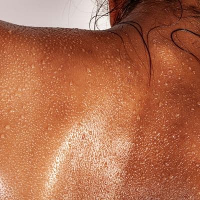 Por qué el sudor y el roce de la ropa favorecen el quiste sebáceo en la espalda