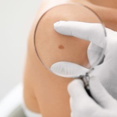 Melanoma amelanótico: el más difícil de detectar a tiempo