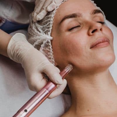 Microneedling: Qué es y cómo transforma tu piel desde la primera sesión