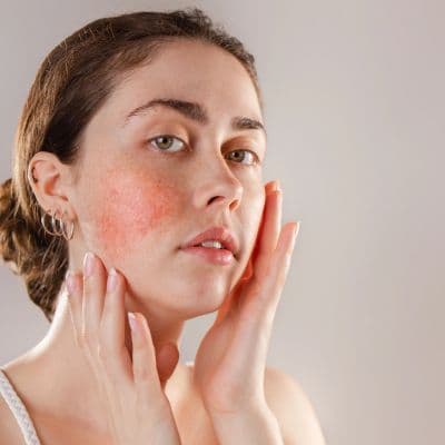 Demodex y Rosácea: la conexión entre el ácaro y el enrojecimiento facial