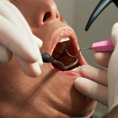 El riesgo de perder tus piezas: cómo frenar la periodontitus a tiempo