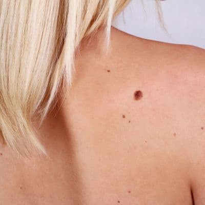 Manchas blancas en la piel tras el verano: ¿es pitiriasis versicolor?