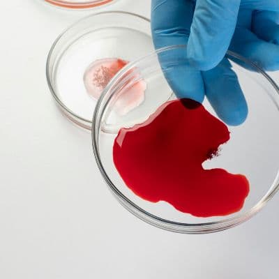 El misterio de tus glóbulos rojos grandes: ¿Qué está fallando en tu sangre?