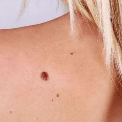 Qué es el melanoma inicial y cómo detectarlo a tiempo
