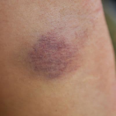 Equimosis espontánea: por qué salen moratones sin golpe
