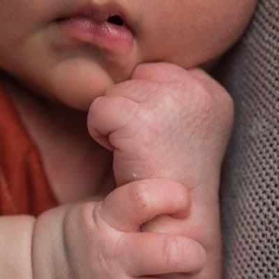 Cómo diferenciar un sarpullido del bebé por calor de una dermatitis atópica