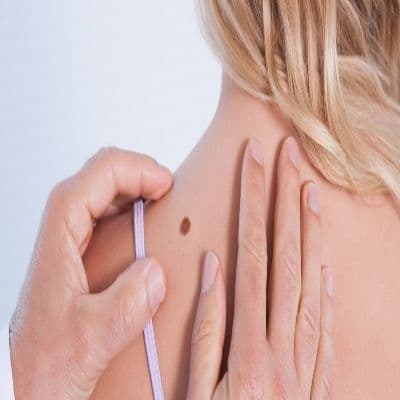 Qué es un dermatofibroma: el bulto duro que sale tras una picadura